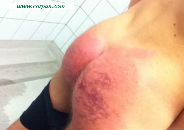 Spanked player's bruised backside