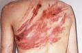Flogged man's back showing wounds
