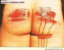 bleeding buttocks after caning